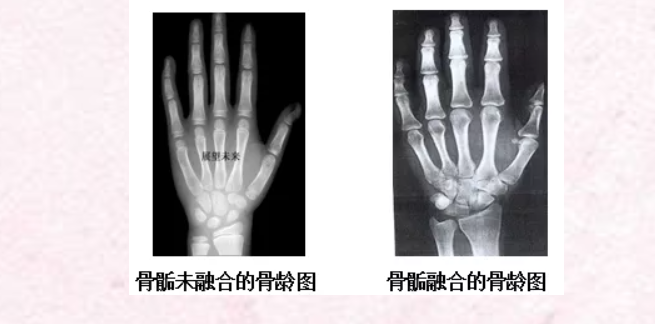 【公益義診】免費(fèi)測骨齡--關(guān)注身高,，助力成長